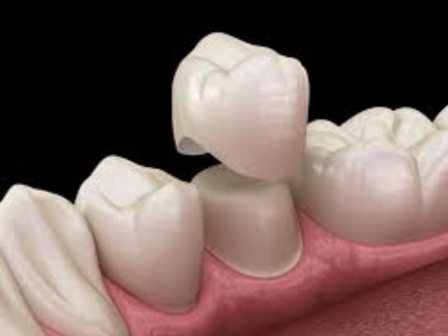 dental crowns 101 what you need to know before getting one