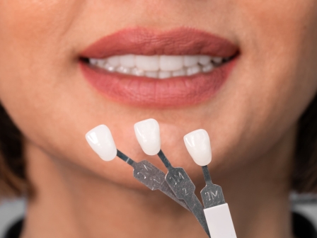 what to consider before getting dental veneers